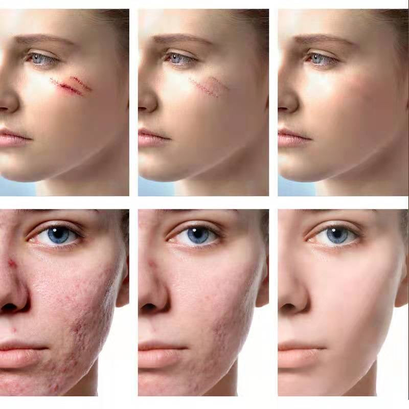 SCAR REMOVAL GEL